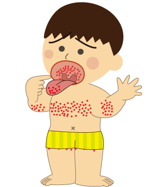 小児にかかりやすい病気「溶連菌性咽頭炎」